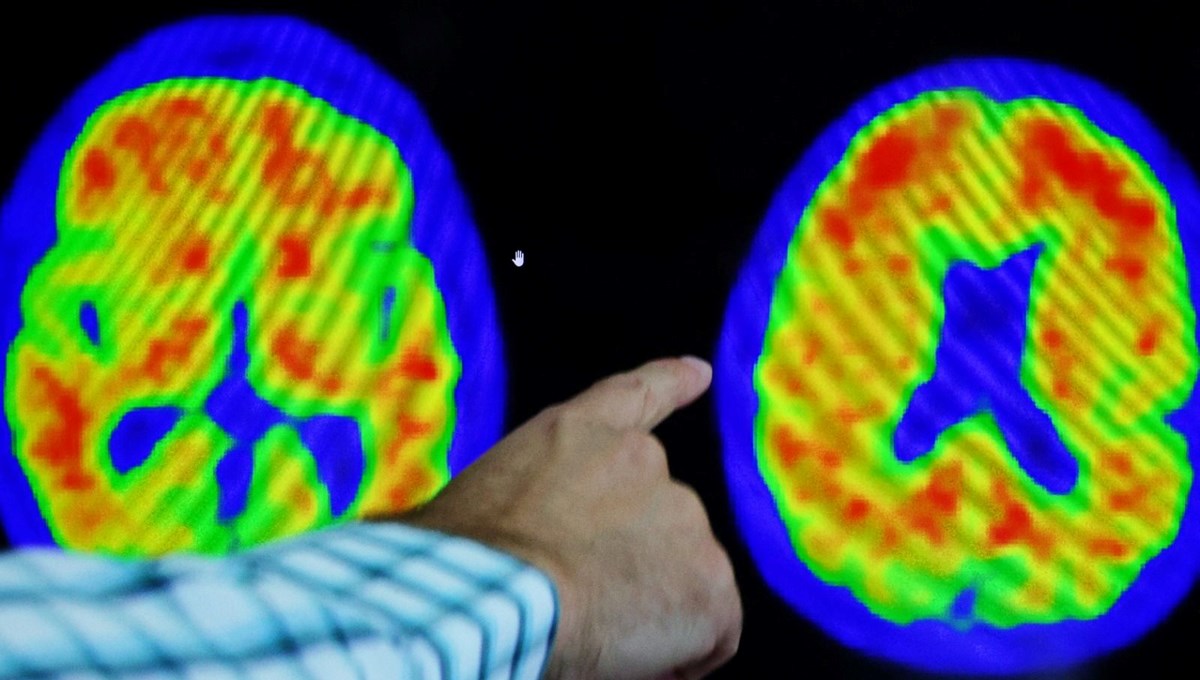Uçuk ve Alzheimer arasında bağlantı keşfedildi