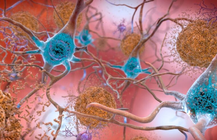 Alzheimer tedavisinde yeni umut: 2 kanser ilacı çare olabilir